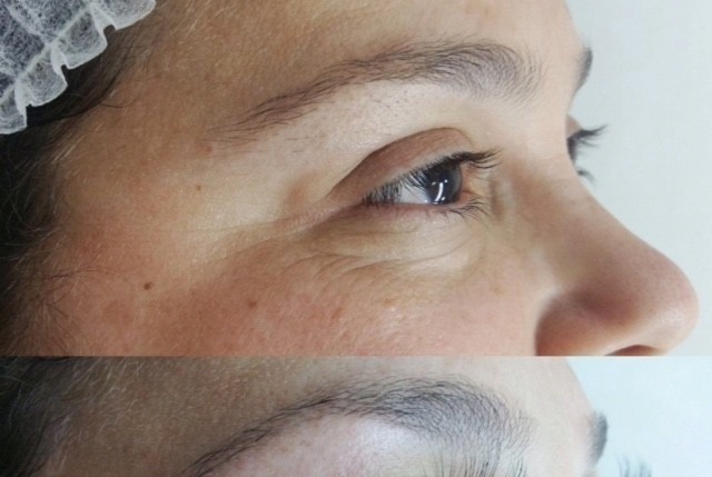 Antes e depois da micropigmentação de sobrancelhas